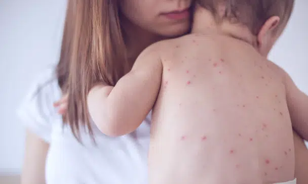 Image of mother holding her child who has chicken pox.