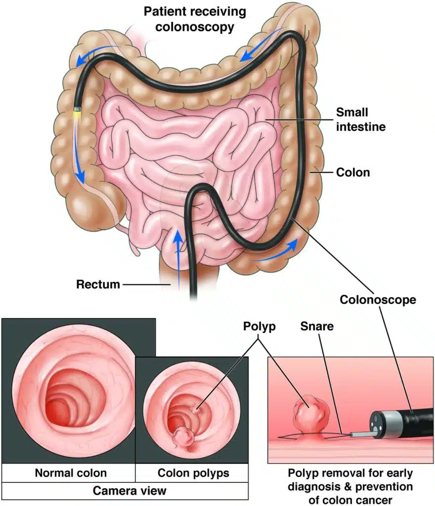 Image displays how polyps are removed.