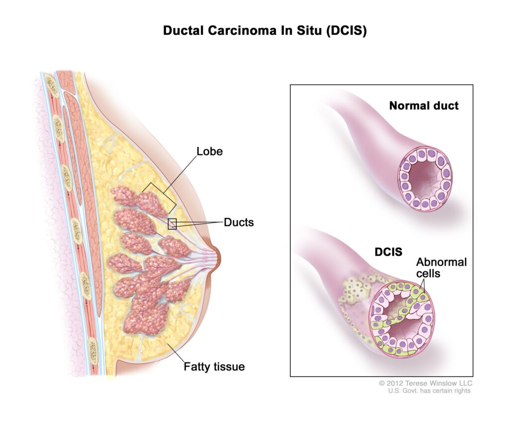 Image of DCIS breast tissue.