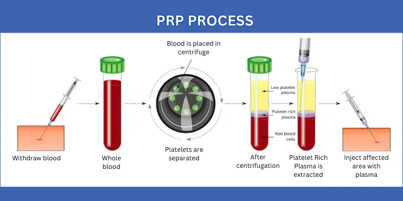 Infographic of Platelet Rich Therapy process.
